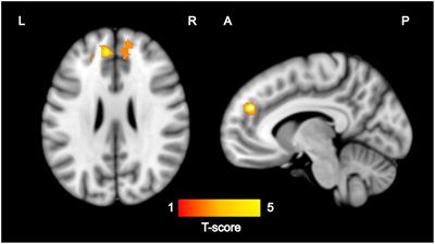 Maternal sensitivity at the age of 8 months associates with local connectivity of the medial prefrontal cortex in children at 5 years of age